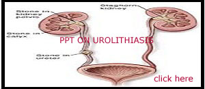 PPT ON UROLITHIASIS