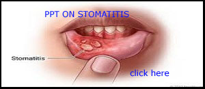 PPT ON CH.STOMATITIS