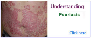 PPT ON PSORIASIS