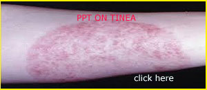 PPT ON TINEA