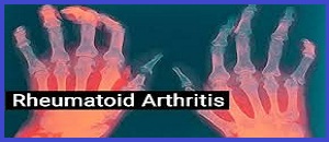 PPT ON RANDOMIZED CONTROL TRIAL INDIVIDUAL HOMOEOPATHY IN RHEUMATOID ARTHRITIS