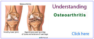 OSTEOARTHRITIS