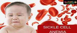 PPT ON SICKLE CELL ANEMIA